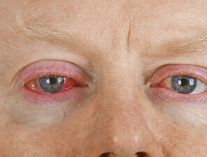 Bild zu Atopische Dermatitis - Wenn Neurodermitis ins Auge geht