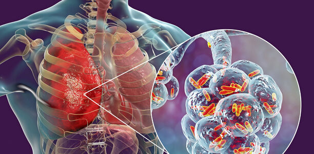 Bild zu Häufige Lungen- und Atemwegsinfektionen - Diagnostik in Pandemiezeiten