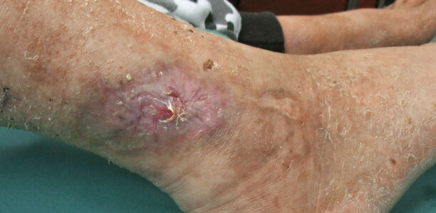 Bild zu Chronisches Ulcus cruris - Ursachen und Therapieoptionen beim „offenen Bein“