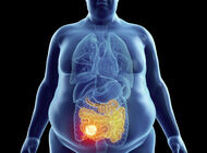 Bild zu Darmkrebs - Hohes Risiko bei jungen Übergewichtigen