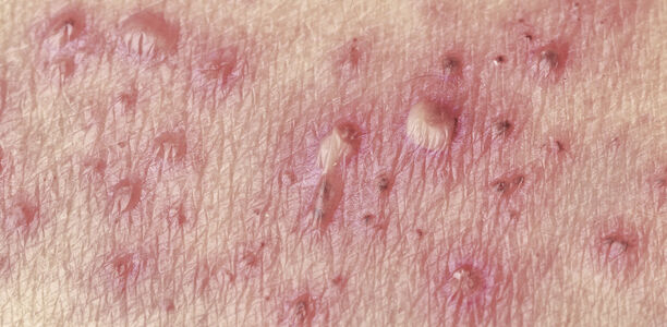 Bild zu Rezidivierende Papeln an verschiedenen Stellen - Gibt es das beim Herpes zoster? 