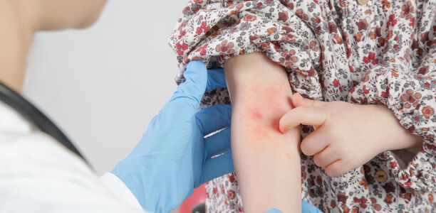 Bild zu Auch in der Hausarztpraxis häufig: - Hautinfektionen bei Kindern